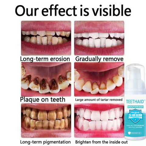 Image of 🔥"Teethaid™🔥 Enjuague bucal, blanqueamiento dental, Curación de úlceras bucales, Eliminación del mal aliento, Prevención y curación de caries